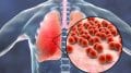 Community Acquired Pneumonia in Adults
