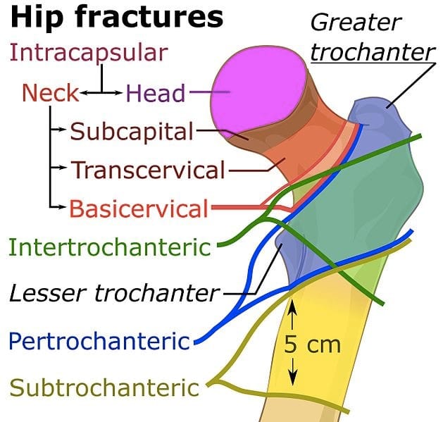 Initial Management of Hip Fractures in Adults