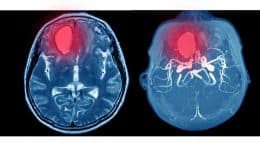 acute headache in adults