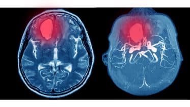 acute headache in adults