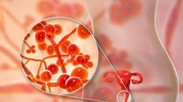 Diagnosis and Management of Vulvovaginitis