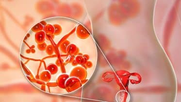 Diagnosis and Management of Vulvovaginitis
