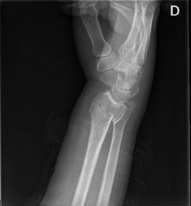 Distal Radius Fractures in Adults