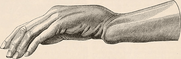 Distal Radius Fractures in Adults