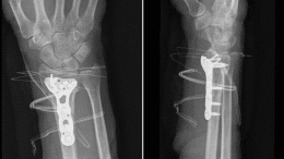 Distal Radius Fractures in Adults