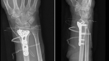 Distal Radius Fractures in Adults