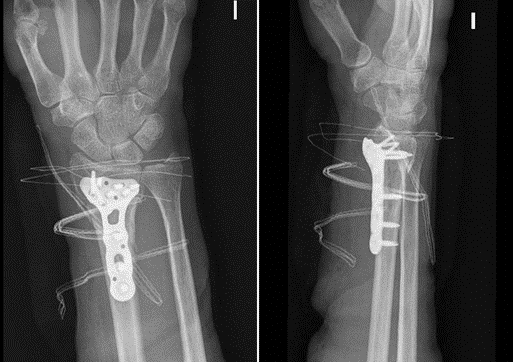 Distal Radius Fractures in Adults