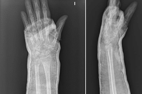 Distal Radius Fractures in Adults