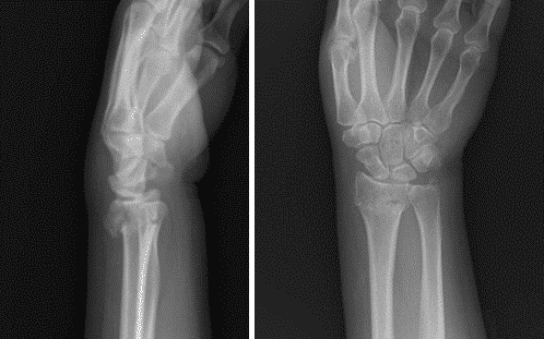 Distal Radius Fractures in Adults